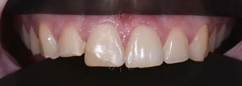 Лучшие зубные клиники Москвы. Художественная реставрация передних зубов - фото до процедуры