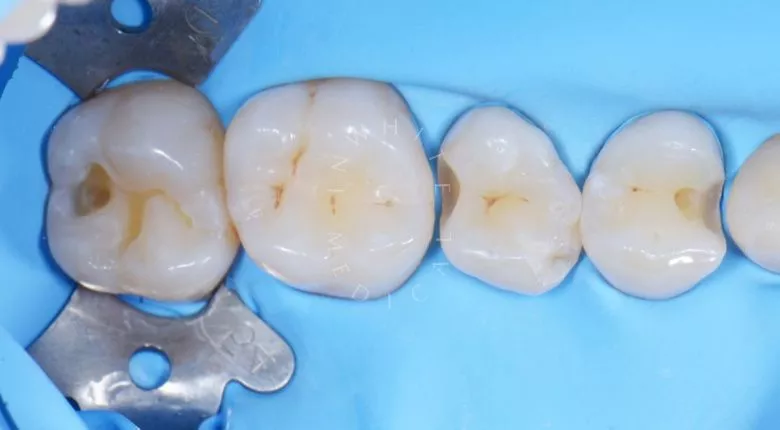 Лучшие стоматологические клиники Москвы. Лечение кариеса 3-х зубов за один визит - фото до процедуры