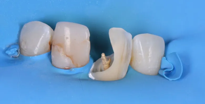 Фото до Эстетическая реставрация зуба в клинике Inwhite Medical