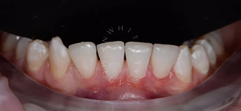 Лучшие стоматологические клиники Москвы.  Восстановление зубов композитными реставрациями перед ортодонтическим лечением - фото после процедуры