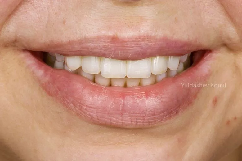 Фото после Тотальная реабилитация зубов после имплантации жевательных сегментов и ортодонтического лечения в клинике Inwhite Medical