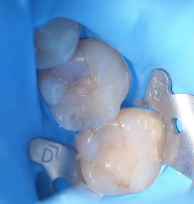 Фото до Глубокий кариес жевательного зуба – сохранение зуба в клинике Inwhite Medical