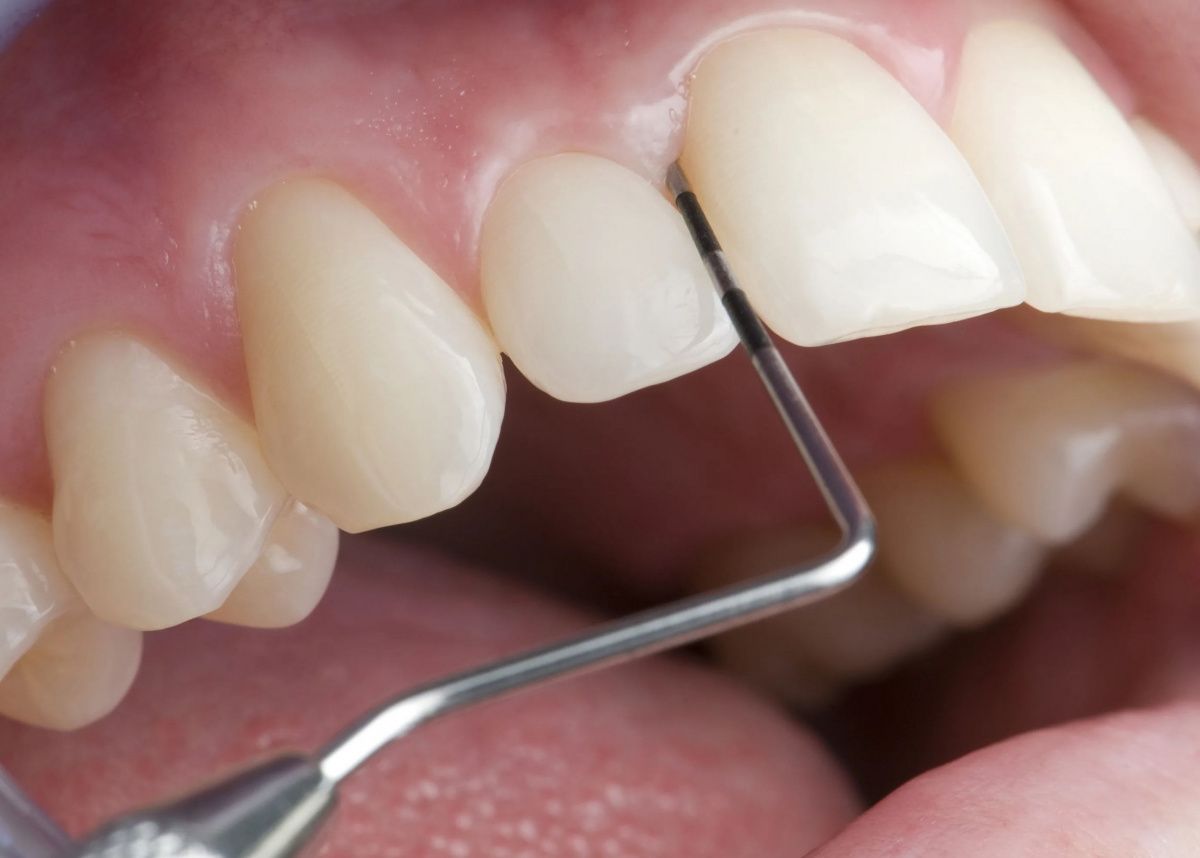 Гингивотомия