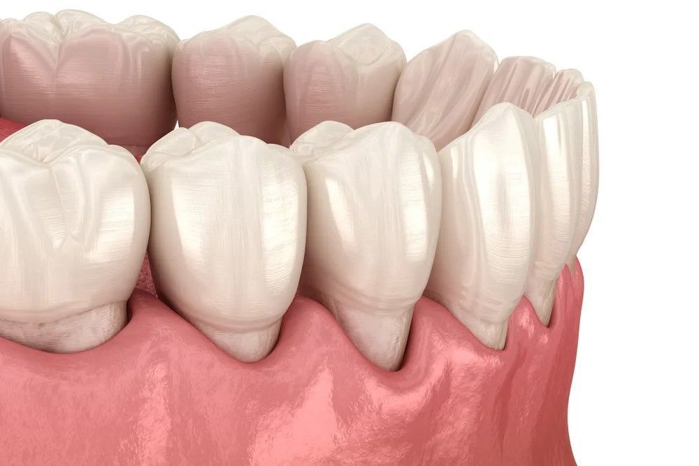 Устранение рецессии десны