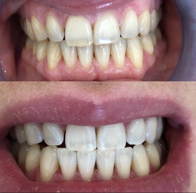 Этапы кабинетного отбеливания зубов