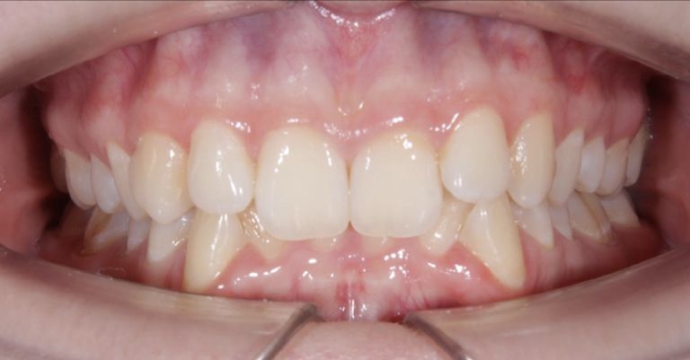 Стоматология премиум класса. Лечение на брекет-системе - before the procedure