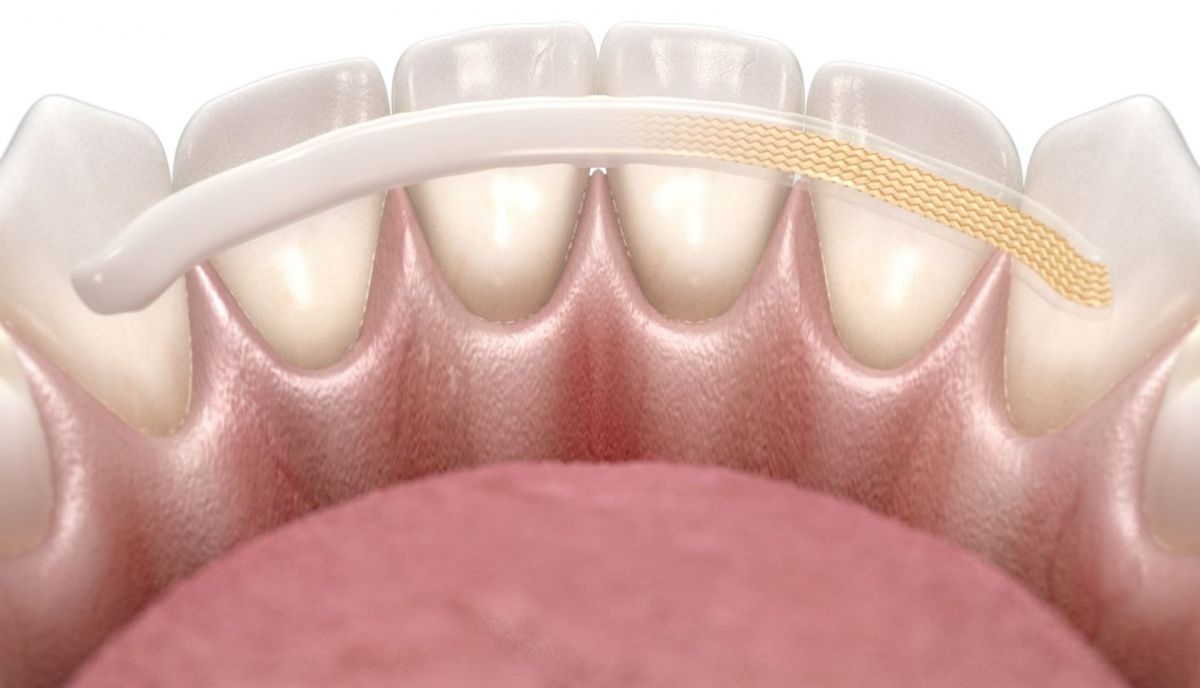 Временное шинирование