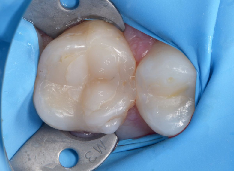 Лучшие зубные клиники Москвы. Скрытый контактный кариес - photo before the procedure