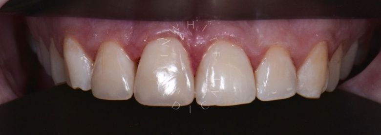 Лучшие зубные клиники Москвы. Художественная реставрация передних зубов - фото после процедуры