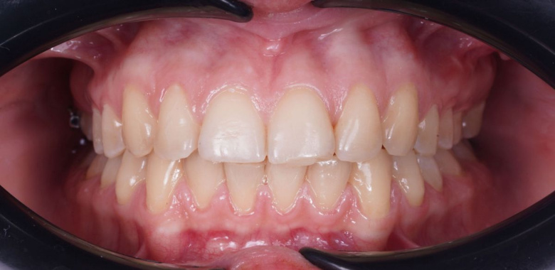 Элитная стоматология. Лечение на брекет-системе - photo after the procedure