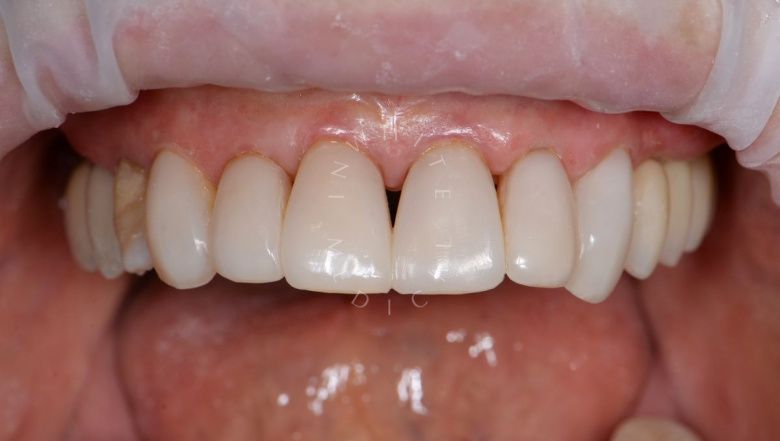 Лучшие стоматологические клиники Москвы.  Композитная реставрация 6 верхних зубов за один визит - фото после процедуры