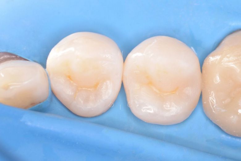 Лучшие стоматологические клиники Москвы. Лечение контактного кариеса - фото после процедуры