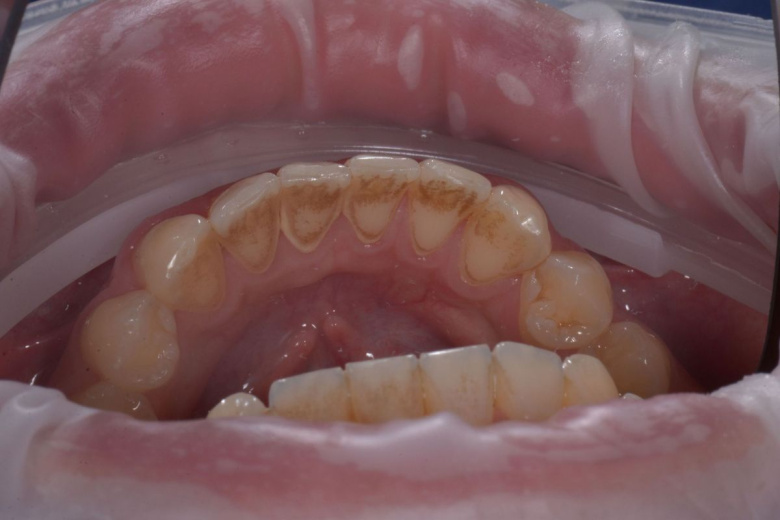 Элитная стоматология. Профессиональная гигиена нижних зубов - photo before the procedure
