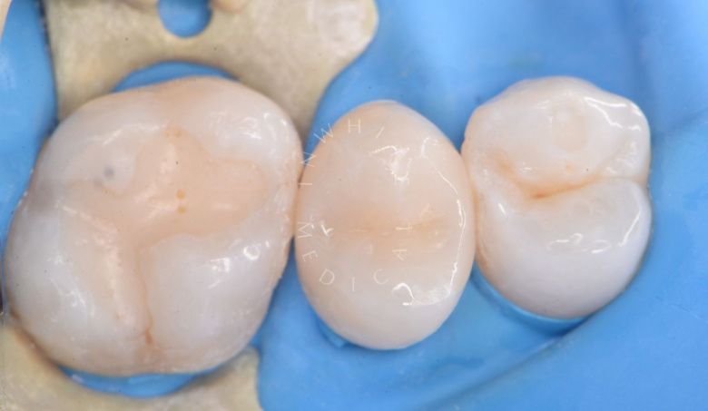 Где лучшая стоматология? Контактный кариес с восстановлением контактного пункта - фото после процедуры