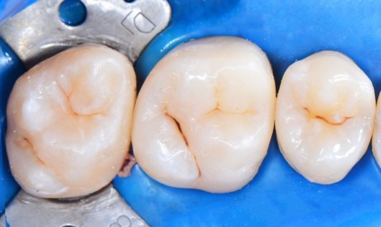 Лучшие стоматологические клиники Москвы. Лечение межзубного кариеса 3-х зубов - фото после процедуры