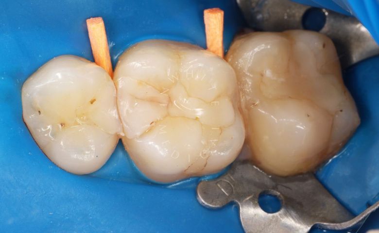 Где лучшая стоматология? Средний кариес с заменой старой пломбы - фото до процедуры