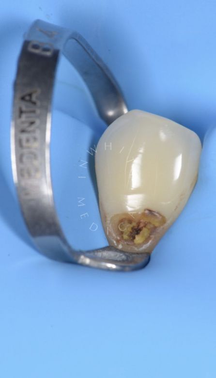 Где лучшая стоматология? Лечение пришеечного глубокого кариеса с использованием микроскопа - фото до процедуры