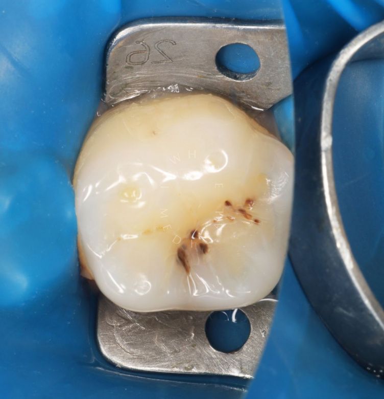 Где лучшая стоматология? Скрытый кариес: диагностика и лечение - фото до процедуры