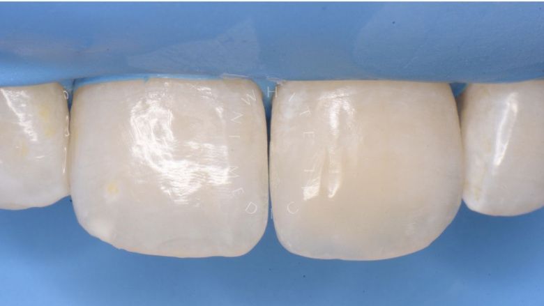 Где лучшая стоматология? Художественная реставрация переднего зуба с использованием композита. Восстановление оптики зуба - фото после процедуры