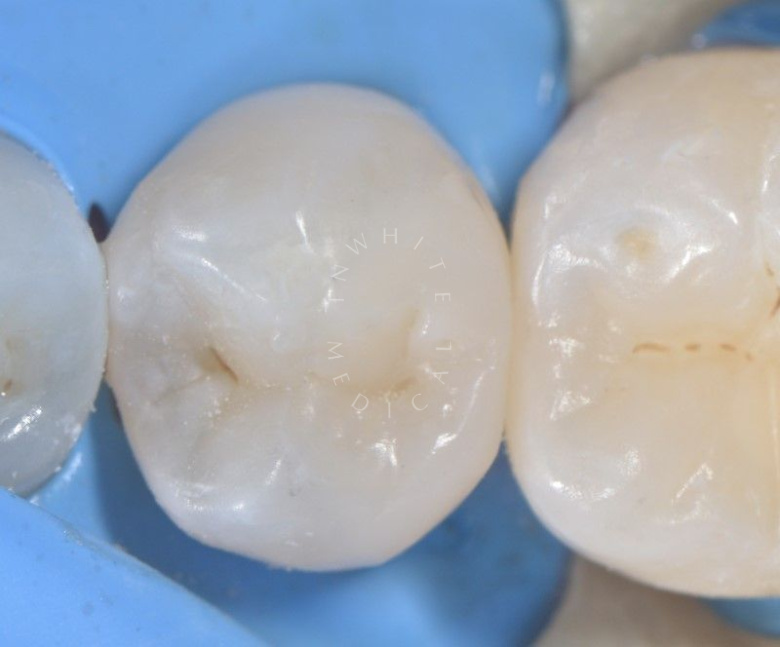 Где лучшая стоматология? Лечение контактного кариеса - photo after the procedure