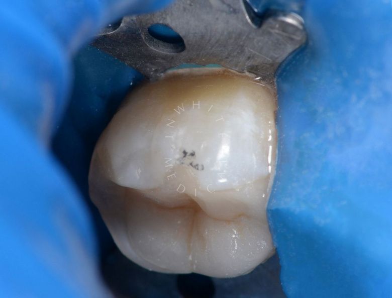 Лучшие стоматологические клиники Москвы. Пришеечный кариес с чувствительностью зуба - фото после процедуры