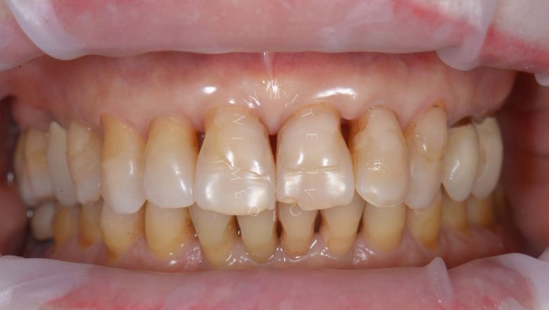 Лучшие стоматологические клиники Москвы.  Композитная реставрация 6 верхних зубов за один визит - фото до процедуры