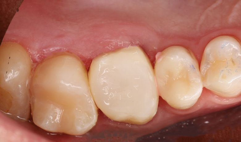 Где лучшая стоматология? Средний кариес жевательной группы зубов - фото после процедуры