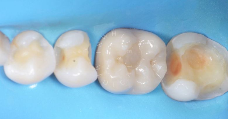 Лучшие стоматологические клиники Москвы. Межзубный кариес зубов и восстановление природной формы фиссур - фото до процедуры