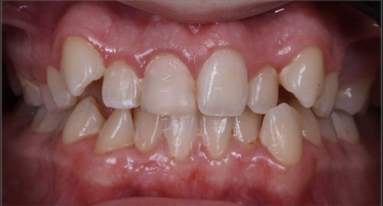 Элитная стоматология. Лечение на элайнерах - photo before the procedure