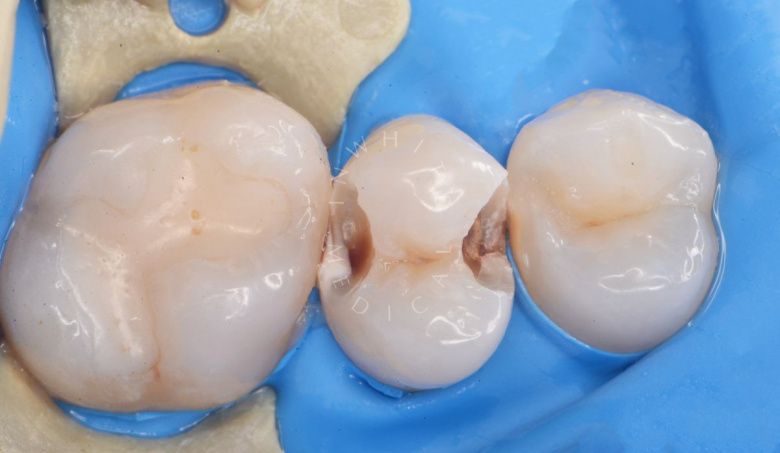 Где лучшая стоматология? Контактный кариес с восстановлением контактного пункта - фото до процедуры