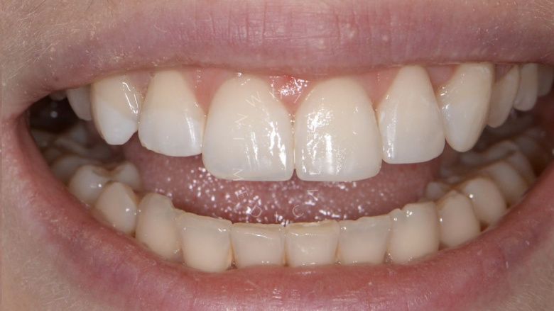 Где лучшая стоматология? Художественная реставрация формы зубов - фото после процедуры