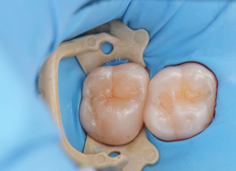 Элитная стоматология. Глубокий кариес с риском пульпита – терапевтический подход - фото после процедуры