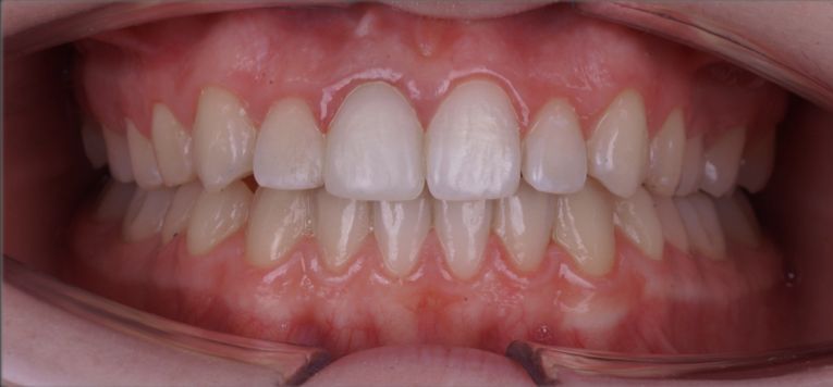 Элитная стоматология. Лечение на элайнерах - photo after the procedure