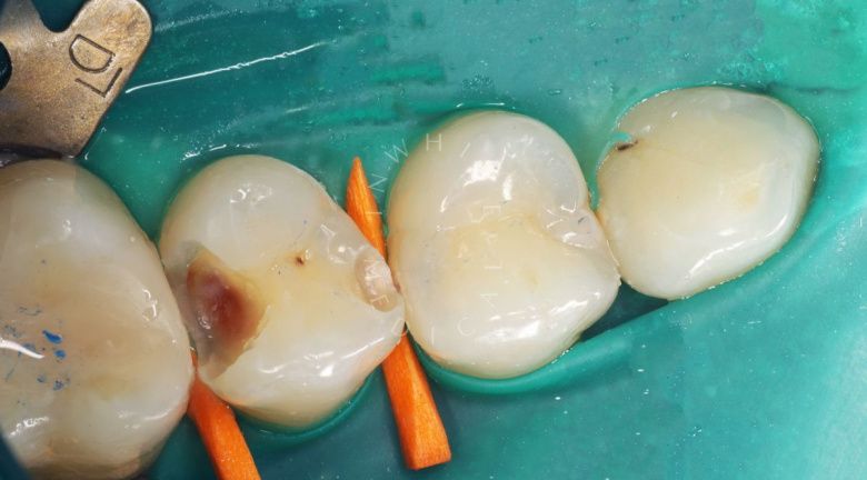 Где лучшая стоматология? Лечение контактного кариеса - фото до процедуры