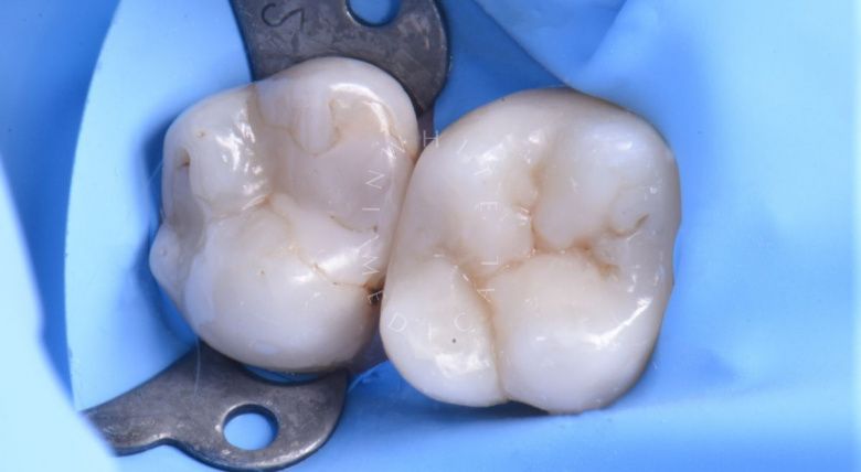 Лучшие зубные клиники Москвы. Контактный кариес под старой пломбой - фото до процедуры