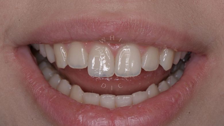 Где лучшая стоматология? Художественная реставрация зуба композитным материалом с восстановлением всех оптических характеристик за один визит. - фото после процедуры