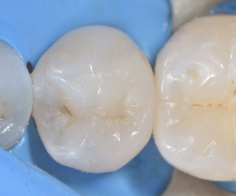 Где лучшая стоматология? Лечение контактного кариеса - фото после процедуры