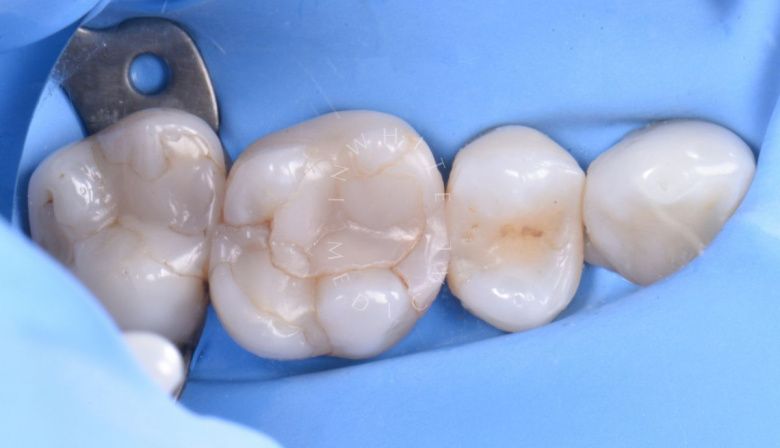 Лучшие зубные клиники Москвы. Средний кариес: лечение и восстановление зуба - фото до процедуры