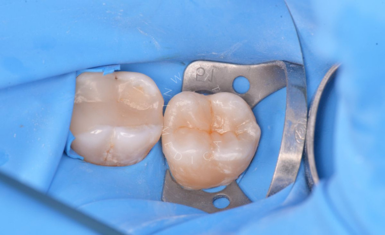 Элитная стоматология. Лечение кариеса жевательного зуба - photo after the procedure