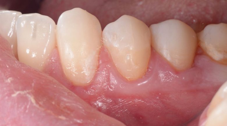 Лучшие зубные клиники Москвы. Пришеечный кариес переднего зуба – художественная реставрация - фото после процедуры