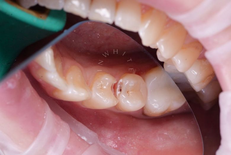 Элитная стоматология. Восстановление зуба после скола – эстетическая реставрация - фото до процедуры
