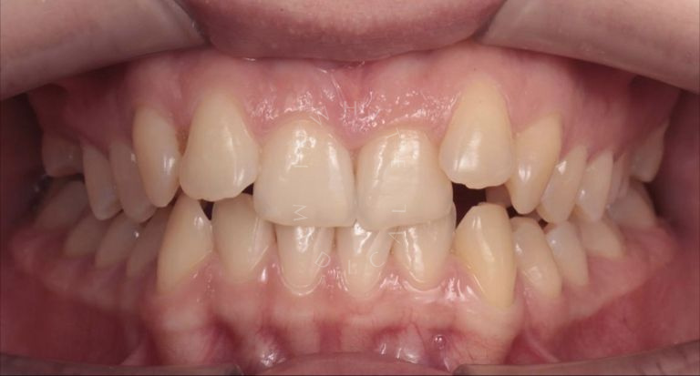 Элитная стоматология. Лечение на брекет-системе - photo before the procedure