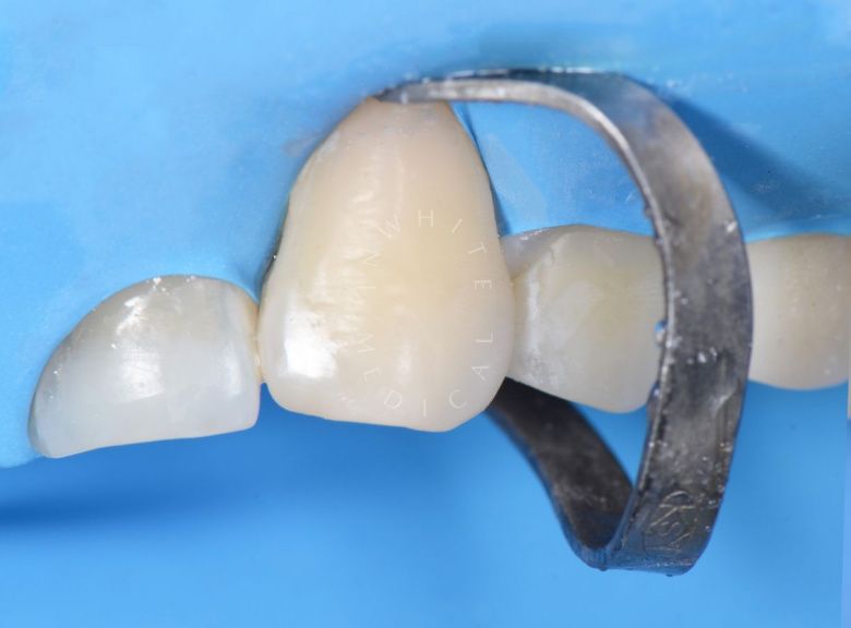 Где лучшая стоматология? Пришеечный кариес: лечение в эстетически значимой зоне - фото после процедуры