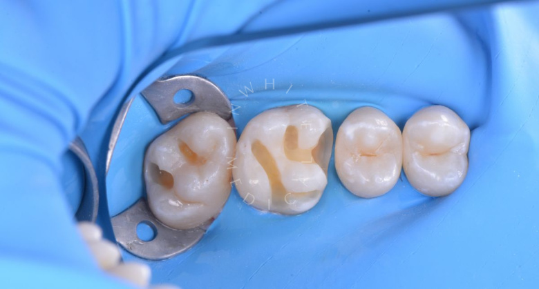Элитная стоматология. Комплексное лечение кариесов зубов - photo before the procedure