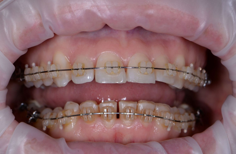 Элитная стоматология. Профессиональная гигиена - photo before the procedure