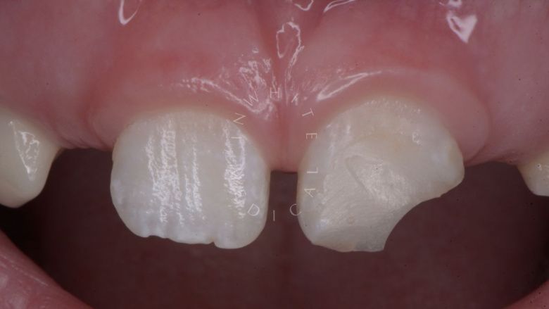 Где лучшая стоматология? Прямая реставрация с использованием композитного материала в одно посещение - фото до процедуры