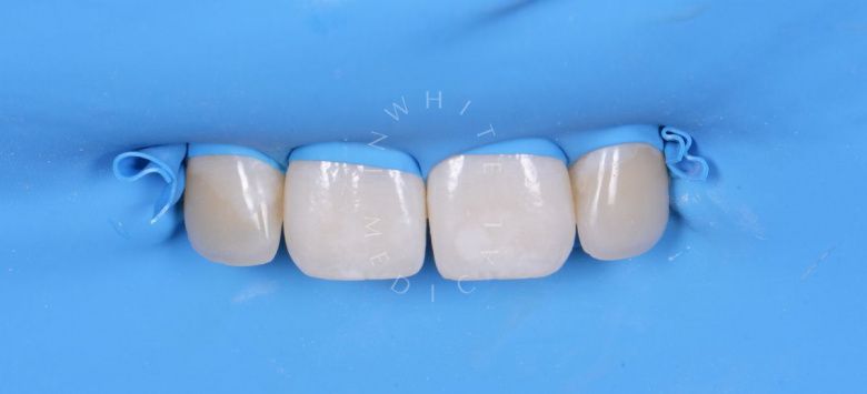 Элитная стоматология. Лечение скрытого межзубного кариеса - фото после процедуры