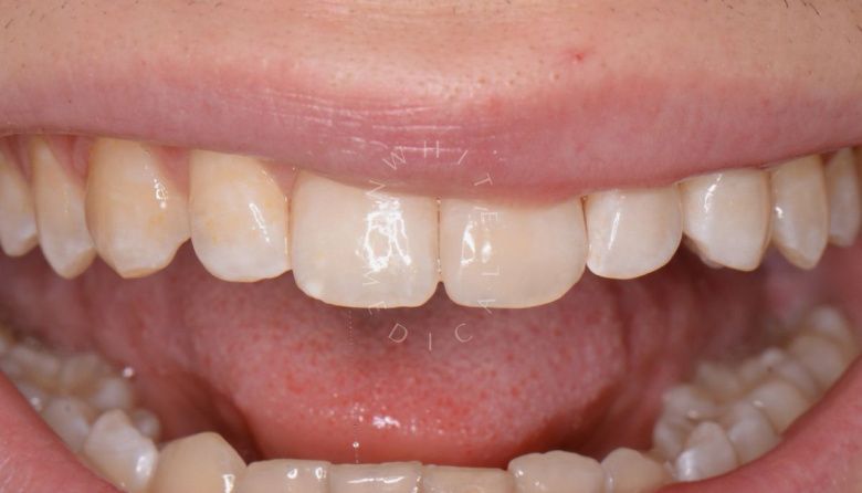 Где лучшая стоматология? Художественная реставрация с использованием композитного материала за один визит - фото после процедуры