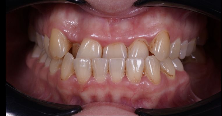 Элитная стоматология. Лечение на элайнерах - photo before the procedure