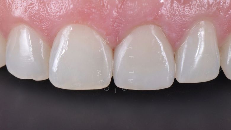 Где лучшая стоматология? Прямая реставрация центрального резца со стекловолоконным штифтом - фото после процедуры